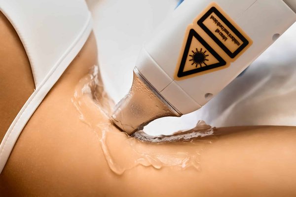 Le détatouage laser est-elle une technique recommandée ?